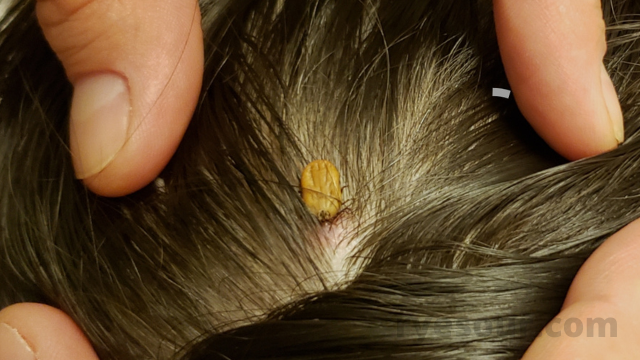A Tick on my child's scalp　マダニ　頭皮　子供